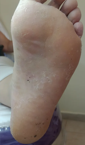 Antes del tratamiento de Hiperqueratosis